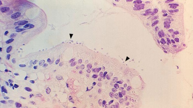 Esta microfotografia revela algumas das mudanças na biópsia do tecido do intestino delgado num caso de criptosporidiose devido a Cryptosporidium